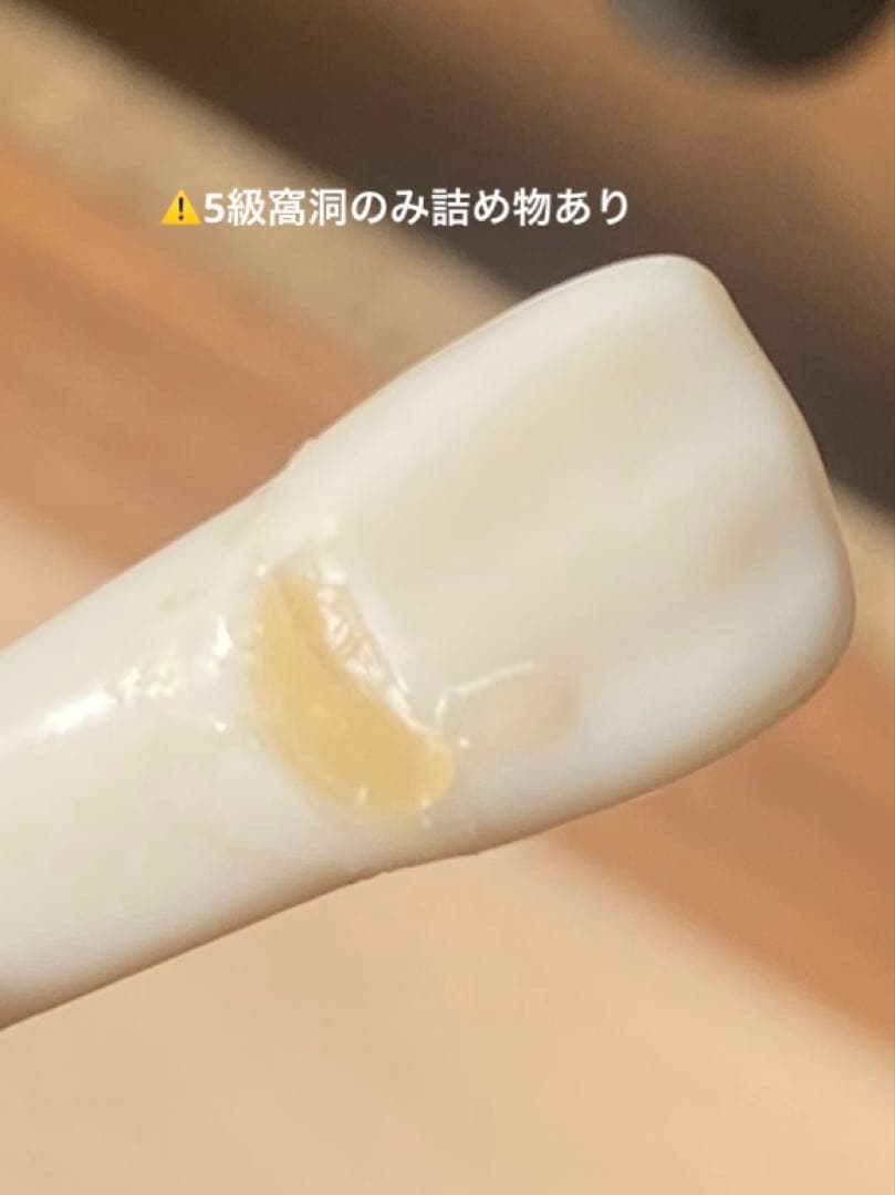 顎模型　人工歯石　セット売り　歯科